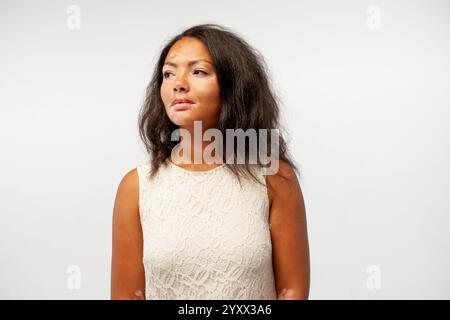Thoughtful female fashion model looking away while standing against plain background. Young lady is with vitiligo skin disease is wearing white dress at studio.  Stock Photo