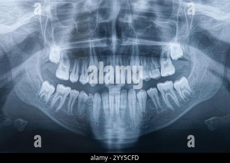 Panoramic shot of the jaw. Orthopantomography, OPG X-ray DR digital wisdom teeth. panoramic film x ray dental. Noisy photo. X-ray scan of patient's ja Stock Photo