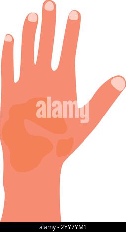 Skin diseases, contact dermatitis. Hand with scratches. Concept of healthcare and medicine. Skin irritation Flat vector illustration Stock Vector