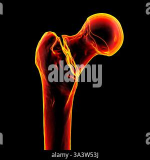 Basicervical Illustration of a basicervical femur fracture, showing a break at the ...
