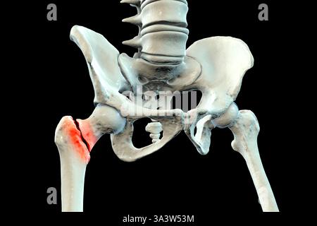 Basicervical Illustration of a basicervical femur fracture, showing a break at the ...