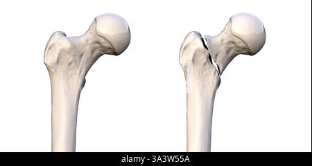 Basicervical Illustration of a femur neck fracture, showing the bone breakage and ...