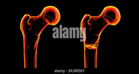 Illustration of a subtrochanteric femur fracture (right) depicting a ...