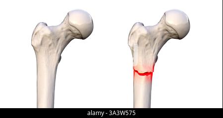 Illustration of a subtrochanteric femur fracture (right) depicting a ...