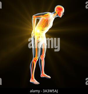 Illustration of a person with lower back pain, emphasising the lumbar region and depicting spinal discomfort, posture and muscular strain. Stock Photo