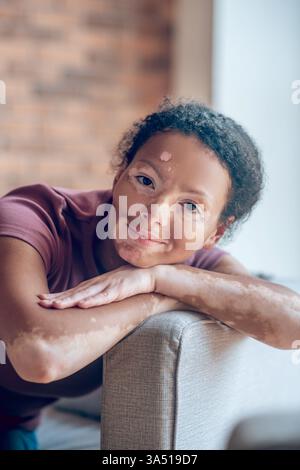 Mixed race woman with vitiligo resting her head on folded arms on a sofa at home. The image emphasizes wellbeing and skin positivity with an authentic, real skin look. Suitable for inclusive beauty, health and lifestyle campaigns. Stock Photo