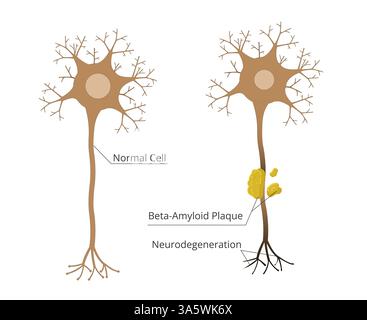 Neural Tangles Alzheimer's Disease, Neurofibrillary Tangles Stock Photo - Alamy