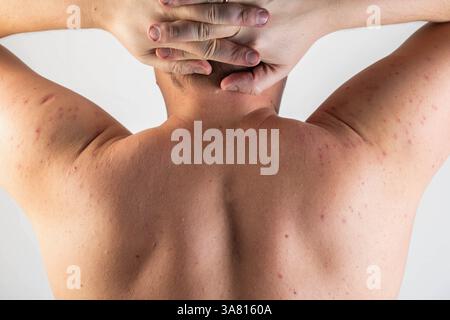 Alcohol Rashes Red spots and rashes on the skin of the back and shoulders after ...