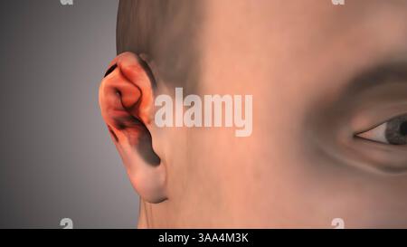 Swollen Ear Anatomy with Auricular Abscess Stock Photo