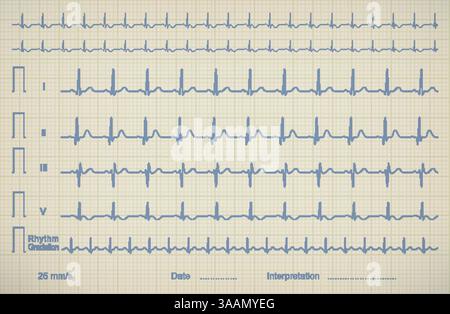 ECG chart image of medical patient, vector illustration Stock Vector
