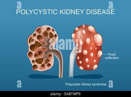Polycystic kidney disease. Close-up of kidney surfase with Fluid collection in cysts. Cross section of human kidney with multiple closed sac. Medical Stock Vector