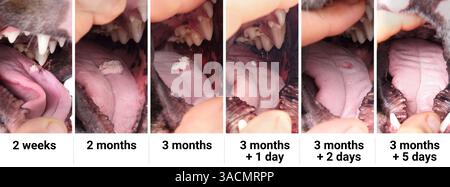 Mouth wart. Papilloma (wart) on the oral mucous surfaces in the mouth ...