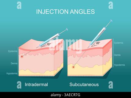 Injection technique. Needle angle. Cross section of human Skin layers with syringe and needle. Subcutaneous and Intradermal injection. Injection site. Stock Vector