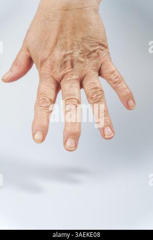 Close-up of the hands of an elderly woman with arthritis of the fingers Stock Photo