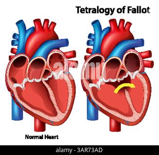 Vector illustration comparing a normal heart with Tetralogy of Fallot. Detailed anatomical features, vibrant colors, educational focus Stock Vector