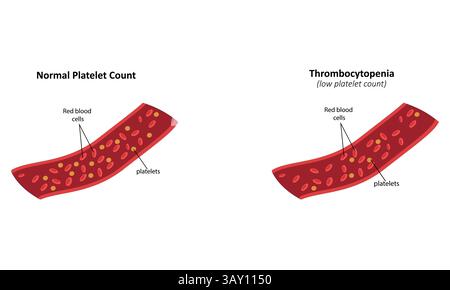 Thrombocytopenia vector illustration. Low platelet count Stock Vector