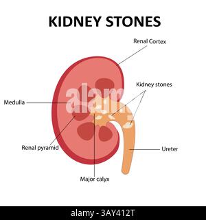 Kidney stones disease vector illustration Stock Vector