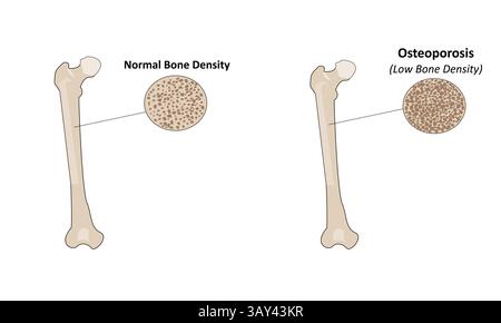 Osteoporosis vector illustration Stock Vector
