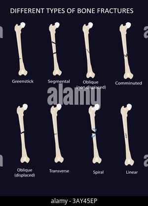 Types of bone fractures vector infographic. comminuted, greenstick, transverse, oblique Stock Vector