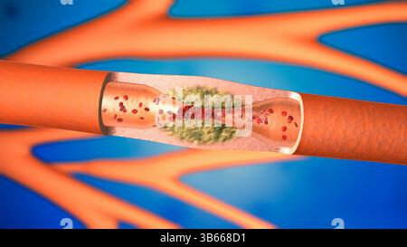 Illustration showing the interior of an artery affected by ...