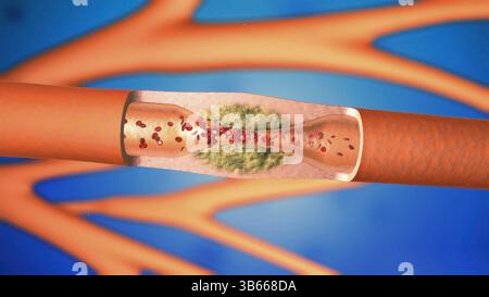 Illustration showing the interior of an artery affected by ...