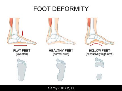 Foot deformity. Healthy feet with normal arch and footprint. Flat feet with low arch, entire sole to touch the ground. Excessively high arch. Vector i Stock Vector