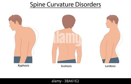 Spine curvature disorders vector illustration Stock Vector