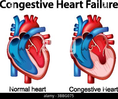 Detailed vector illustration comparing normal and congestive hearts. Vivid colors highlight anatomical differences and medical conditions Stock Vector