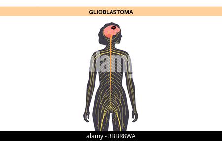 Visual Reference: Illustration Of A Glioblastoma This Is A Highly Aggressive Cancerous