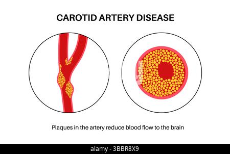 Illustration of carotid artery disease. This occurs when fatty deposits ...