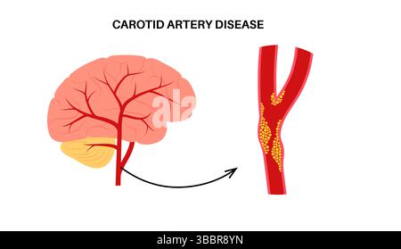 Illustration of carotid artery disease. This occurs when fatty deposits ...