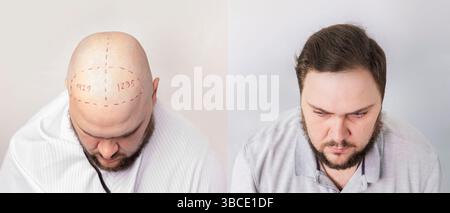 before and after bald head of a man . the process of hair transplantation on the head. treatment of baldness. Stock Photo