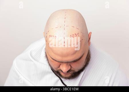 process of hair transplantation on the head. treatment of baldness. bald head of a man. Stock Photo