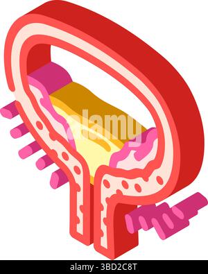hydronephrosis urology isometric icon vector illustration Stock Vector ...