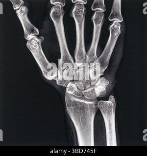 Mid 20th century X-ray photograph / radiograph showing bursitis in the ...
