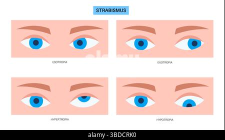 Illustration of strabismus. Also known as eye misalignment, this is a ...