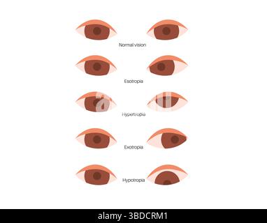 Illustration of strabismus. Also known as eye misalignment, this is a ...
