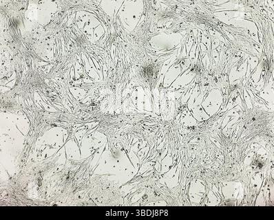 Glioblastoma cell culture. Human malignant astrocytoma cells under a microscope. Stock Photo
