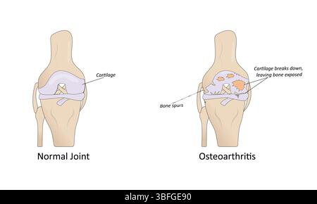 Knee osteoarthritis. Joint degeneration. Vector illustration Stock ...