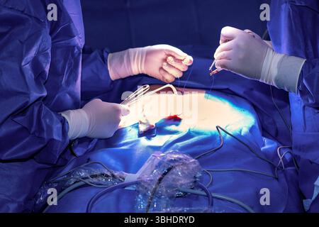 LK Osnabrück, Deutschland 30. Januar 2023: Im Bild: Dieses Szenario beschreibt den präzisen Abschluss eines minimalinvasiven Eingriffs in einem Operationssaal eines Krankenhauses. Der Operateur, in steriler OP-Kleidung und mit chirurgischen Handschuhen, ist dabei, die kleinen Hautschnitte an der Bauchdecke des Patienten zu vernähen, die zuvor für die Laparoskopie oder einen ähnlichen endoskopischen Eingriff gesetzt wurden. Die Hand des Chirurgen führt die Nadel und den Faden mit äußerster Sorgfalt und Präzision, um eine ästhetische Wundheilung und minimale Narbenbildung zu gewährleisten. Die S Stock Photo