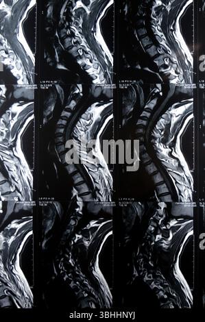 MRI of cervical spine reveals Spondylodegenerative changes along the ...