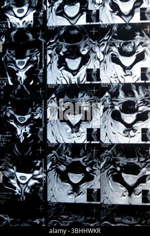 MRI of cervical spine reveals Spondylodegenerative changes along the ...