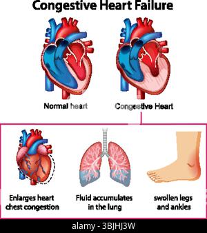 Detailed vector illustration comparing normal and congestive heart conditions, highlighting symptoms like fluid accumulation and swelling Stock Vector
