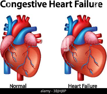 Detailed vector illustration comparing normal heart anatomy with heart failure. Vivid colors and clear labels enhance understanding Stock Vector