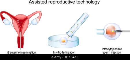 Assisted reproductive technology. In vitro fertilization. Intrauterine insemination and Intracytoplasmic sperm injection. fertility treatment. Detaile Stock Vector