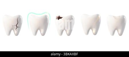 A set of healthy and damaged teeth. A tooth with a crack, filling, caries, and protection. Dentistry, dental care, orthodontics, oral health concept. 3D vector illustration on a white background Stock Vector