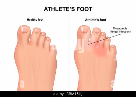 Athlete's foot, illustration Stock Photo - Alamy