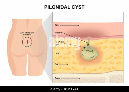 Pilonoidal Abscess Incision Pilonidal Sinus illustration Stock Photo - Alamy