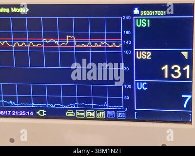 Cardiotocography device placed on mother's abdomen recording the fetal ...