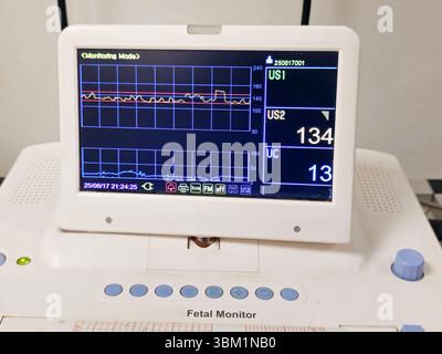 Cardiotocogramme Cardiotocography device placed on mother's abdomen recording the fetal ...
